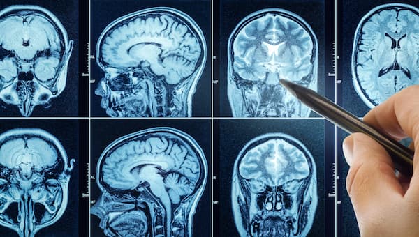 Concussion Effects