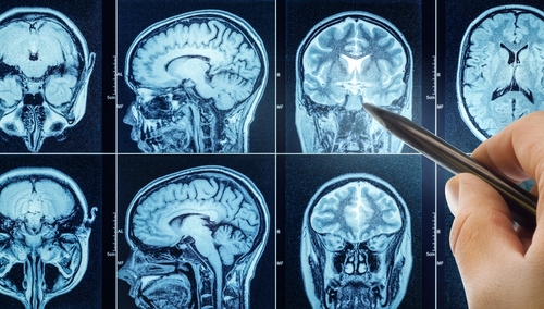 Brain Bleeds & Stroke
