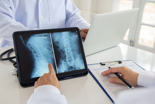 Spinal Stenosis