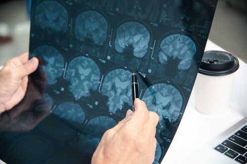 Debunking Myths About MRIs and Car Accident Injuries